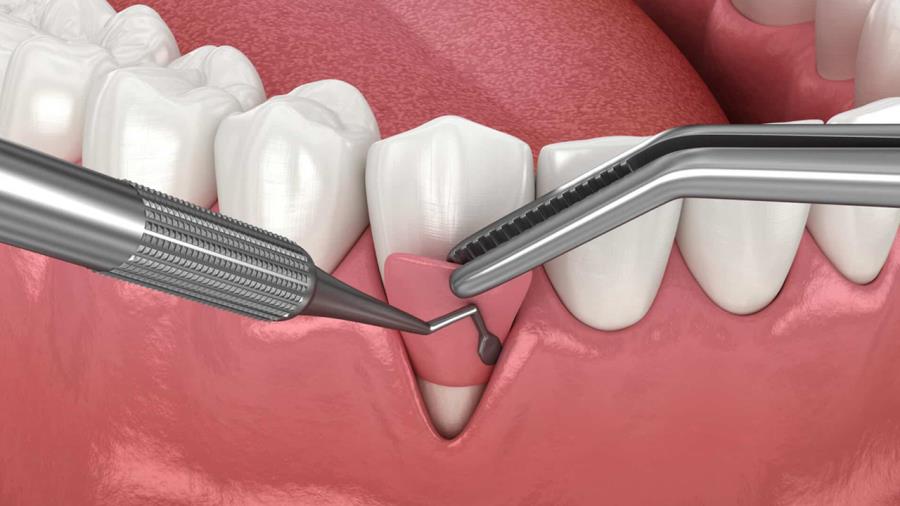 توقف خون‌ریزی و بازسازی استخوان با فناوری نانو در دندان‌پزشکی
